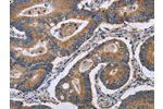 The image is immunohistochemistry of paraffin-embedded Human colon cancer tissue using CSB-PA022040(GABPB2 Antibody) at dilution 1/30. (Original magnification: 