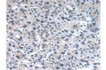 The image on the left is immunohistochemistry of paraffin-embedded Human liver cancer tissue using CSB-PA022208(CLDN19 Antibody) at dilution 1/30, on the right is treated with synthetic peptide. (Original magnification: 