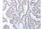 The image on the left is immunohistochemistry of paraffin-embedded Human thyroid cancer tissue using CSB-PA022273(ACTL8 Antibody) at dilution 1/15, on the right is treated with fusion protein. (Original magnification: 