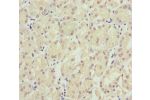 Immunohistochemistry of paraffin-embedded human gastric cancer using CSB-PA022583ESR1HU at dilution of 1:100