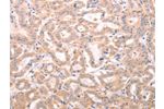 The image on the left is immunohistochemistry of paraffin-embedded Human thyroid cancer tissue using CSB-PA022733(ABHD12 Antibody) at dilution 1/25, on the right is treated with fusion protein. (Original magnification: 