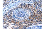 The image on the left is immunohistochemistry of paraffin-embedded Human esophagus cancer tissue using CSB-PA023160(CLEC2B Antibody) at dilution 1/50, on the right is treated with fusion protein. (Original magnification: 