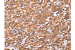 The image on the left is immunohistochemistry of paraffin-embedded Human thyroid cancer tissue using CSB-PA023220(FAM13B Antibody) at dilution 1/20, on the right is treated with synthetic peptide. (Original magnification: 