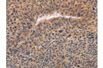 The image on the left is immunohistochemistry of paraffin-embedded Human liver cancer tissue using CSB-PA023292(ADAMDEC1 Antibody) at dilution 1/20, on the right is treated with fusion protein. (Original magnification: 