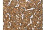 The image on the left is immunohistochemistry of paraffin-embedded Human liver cancer tissue using CSB-PA023517(ENTPD5 Antibody) at dilution 1/20, on the right is treated with fusion protein. (Original magnification: 