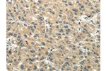 The image on the left is immunohistochemistry of paraffin-embedded Human liver cancer tissue using CSB-PA025080(CHGB Antibody) at dilution 1/40, on the right is treated with synthetic peptide. (Original magnification: 
