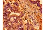 Immunohistochemistry of paraffin-embedded human colon cancer using CSB-PA025168LA01HU at dilution of 1:100