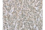 The image on the left is immunohistochemistry of paraffin-embedded Human esophagus cancer tissue using CSB-PA025575(EDA2R Antibody) at dilution 1/50, on the right is treated with fusion protein. (Original magnification: 