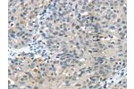 The image on the left is immunohistochemistry of paraffin-embedded Human breast cancer tissue using CSB-PA025580(GLP2R Antibody) at dilution 1/30, on the right is treated with fusion protein. (Original magnification: 