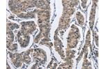 The image on the left is immunohistochemistry of paraffin-embedded Human breast cancer tissue using CSB-PA025645(DSG2 Antibody) at dilution 1/50, on the right is treated with fusion protein. (Original magnification: 
