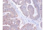Immunohistochemistry of paraffin-embeded human colorectal carcinoma using CSB-PA02604A0Rb at dilution of 1:100