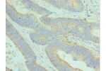 Immunohistochemistry of paraffin-embedded human colon cancer using CSB-PA026056ESR2HU at dilution 1:100
