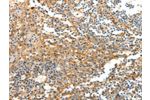 The image on the left is immunohistochemistry of paraffin-embedded Human tonsil tissue using CSB-PA026205(DTX3 Antibody) at dilution 1/20, on the right is treated with fusion protein. (Original magnification: 