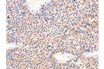 The image on the left is immunohistochemistry of paraffin-embedded Human liver cancer tissue using CSB-PA026505(AMPD1 Antibody) at dilution 1/70, on the right is treated with synthetic peptide. (Original magnification: 