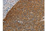 The image on the left is immunohistochemistry of paraffin-embedded Human cervical cancer tissue using CSB-PA027320(FOXF2 Antibody) at dilution 1/30, on the right is treated with synthetic peptide. (Original magnification: 