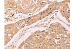 The image on the left is immunohistochemistry of paraffin-embedded Human breast cancer tissue using CSB-PA027485(ADH1B Antibody) at dilution 1/40, on the right is treated with synthetic peptide. (Original magnification: 