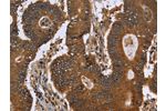 The image on the left is immunohistochemistry of paraffin-embedded Human colon cancer tissue using CSB-PA028033(FGFRL1 Antibody) at dilution 1/40, on the right is treated with fusion protein. (Original magnification: 