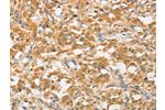 The image on the left is immunohistochemistry of paraffin-embedded Human thyroid cancer tissue using CSB-PA028037(ATG5 Antibody) at dilution 1/40, on the right is treated with fusion protein. (Original magnification: 