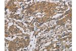 The image is immunohistochemistry of paraffin-embedded Human gastic cancer tissue using CSB-PA029843(ARF6 Antibody) at dilution 1/20. (Original magnification: 