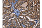 The image on the left is immunohistochemistry of paraffin-embedded Human thyroid cancer tissue using CSB-PA030360(EPHB6 Antibody) at dilution 1/40, on the right is treated with fusion protein. (Original magnification: 