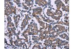 The image on the left is immunohistochemistry of paraffin-embedded Human breast cancer tissue using CSB-PA030856(AGFG1 Antibody) at dilution 1/50, on the right is treated with fusion protein. (Original magnification: 