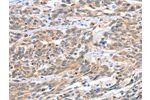 The image on the left is immunohistochemistry of paraffin-embedded Human esophagus cancer tissue using CSB-PA030984(CGB Antibody) at dilution 1/60, on the right is treated with fusion protein. (Original magnification: 