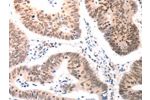 The image on the left is immunohistochemistry of paraffin-embedded Human colon cancer tissue using CSB-PA031026(BDKRB2 Antibody) at dilution 1/50, on the right is treated with synthetic peptide. (Original magnification: 