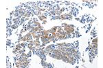 The image on the left is immunohistochemistry of paraffin-embedded Human lung cancer tissue using CSB-PA031049(Ccl6 Antibody) at dilution 1/50, on the right is treated with synthetic peptide. (Original magnification: 
