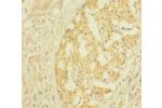 Immunohistochemistry of paraffin-embedded human pancreatic cancer using CSB-PA03147A0Rb at dilution 1:100