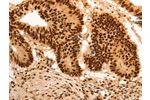 The image on the left is immunohistochemistry of paraffin-embedded Human colon cancer tissue using CSB-PA031927(E2F7 Antibody) at dilution 1/60, on the right is treated with synthetic peptide. (Original magnification: 