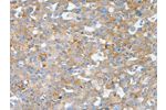 The image on the left is immunohistochemistry of paraffin-embedded Human breast cancer tissue using CSB-PA032305(BPIFB2 Antibody) at dilution 1/50, on the right is treated with synthetic peptide. (Original magnification: 