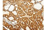 The image on the left is immunohistochemistry of paraffin-embedded Human thyroid cancer tissue using CSB-PA032335(FZD6 Antibody) at dilution 1/60, on the right is treated with synthetic peptide. (Original magnification: 