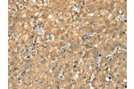 The image on the left is immunohistochemistry of paraffin-embedded Human liver cancer tissue using CSB-PA032471(CWC27 Antibody) at dilution 1/20, on the right is treated with synthetic peptide. (Original magnification: 