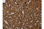 The image on the left is immunohistochemistry of paraffin-embedded Human prostate cancer tissue using CSB-PA032562(ARHGEF12 Antibody) at dilution 1/20, on the right is treated with synthetic peptide. (Original magnification: 