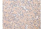 The image on the left is immunohistochemistry of paraffin-embedded Human liver cancer tissue using CSB-PA032749(DUSP11 Antibody) at dilution 1/25, on the right is treated with fusion protein. (Original magnification: 