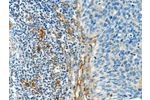 The image on the left is immunohistochemistry of paraffin-embedded Human cervical cancer tissue using CSB-PA033015(DIO2 Antibody) at dilution 1/50, on the right is treated with synthetic peptide. (Original magnification: 