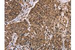 The image on the left is immunohistochemistry of paraffin-embedded Human cervical cancer tissue using CSB-PA033256(EDN2 Antibody) at dilution 1/30, on the right is treated with fusion protein. (Original magnification: 