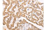 The image on the left is immunohistochemistry of paraffin-embedded Human thyroid cancer tissue using CSB-PA033338(ATPIF1 Antibody) at dilution 1/60, on the right is treated with fusion protein. (Original magnification: 