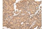 The image on the left is immunohistochemistry of paraffin-embedded Human prostate cancer tissue using CSB-PA033785(ALDH3A2 Antibody) at dilution 1/20, on the right is treated with fusion protein. (Original magnification: 