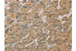 The image on the left is immunohistochemistry of paraffin-embedded Human liver cancer tissue using CSB-PA033966(CYP27A1 Antibody) at dilution 1/25, on the right is treated with fusion protein. (Original magnification: 
