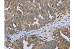 The image on the left is immunohistochemistry of paraffin-embedded Human ovarian cancer tissue using CSB-PA034013(DCTN4 Antibody) at dilution 1/50, on the right is treated with fusion protein. (Original magnification: 