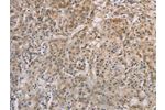 The image on the left is immunohistochemistry of paraffin-embedded Human gastic cancer tissue using CSB-PA034482(ESRRG Antibody) at dilution 1/30, on the right is treated with fusion protein. (Original magnification: 