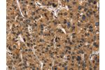 The image on the left is immunohistochemistry of paraffin-embedded Human liver cancer tissue using CSB-PA034616(DEFA5 Antibody) at dilution 1/15, on the right is treated with synthetic peptide. (Original magnification: 