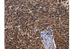 The image on the left is immunohistochemistry of paraffin-embedded Human cervical cancer tissue using CSB-PA034661(FASTKD5 Antibody) at dilution 1/40, on the right is treated with fusion protein. (Original magnification: 