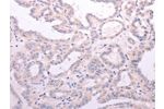 The image on the left is immunohistochemistry of paraffin-embedded Human thyroid cancer tissue using CSB-PA035040(ACOT2 Antibody) at dilution 1/15, on the right is treated with fusion protein. (Original magnification: 