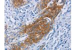 The image on the left is immunohistochemistry of paraffin-embedded Human esophagus cancer tissue using CSB-PA035070(CCR9 Antibody) at dilution 1/60, on the right is treated with fusion protein. (Original magnification: 