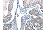 The image on the left is immunohistochemistry of paraffin-embedded Human breast cancer tissue using CSB-PA035138(Ccl6 Antibody) at dilution 1/50, on the right is treated with synthetic peptide. (Original magnification: 