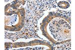 The image on the left is immunohistochemistry of paraffin-embedded Human colon cancer tissue using CSB-PA035369(EFNB2 Antibody) at dilution 1/80, on the right is treated with fusion protein. (Original magnification: 