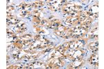 The image on the left is immunohistochemistry of paraffin-embedded Human thyroid cancer tissue using CSB-PA035949(APOL6 Antibody) at dilution 1/50, on the right is treated with synthetic peptide. (Original magnification: 
