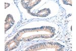 The image on the left is immunohistochemistry of paraffin-embedded Human colon cancer tissue using CSB-PA036665(FHL5 Antibody) at dilution 1/20, on the right is treated with fusion protein. (Original magnification: 